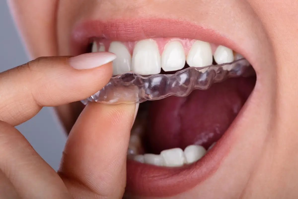 Person inserting clear dental aligner into mouth.